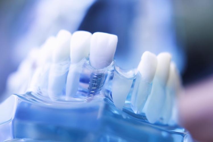 据国海证券一份研究报告表示,义齿(假牙)包括活动义齿,固定义齿,种植