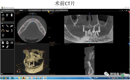 即刻拔除,即刻种植,即刻负重 您还在等什么